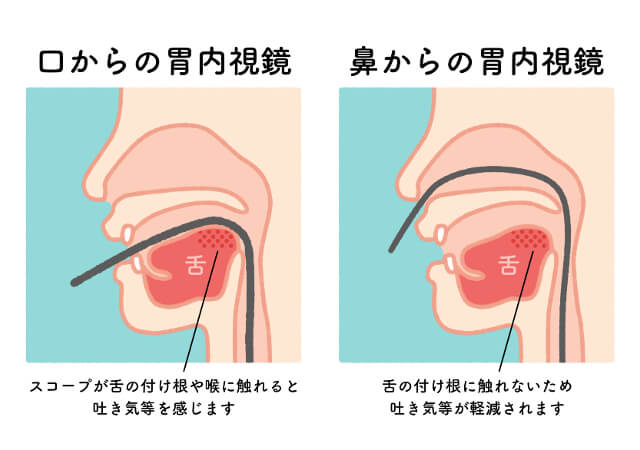 胃カメラ検査は経口、経鼻どっちが楽か